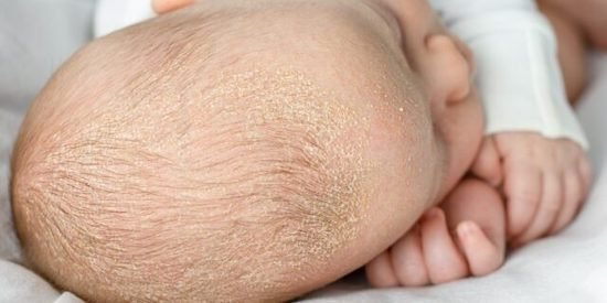 Crosta lattea neonato come eliminarla, i sintomi, le cause